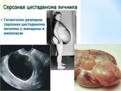 серозная цитаденома в менопаузе
