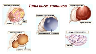 типы кист яичников