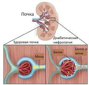 Влияние диабета на почки