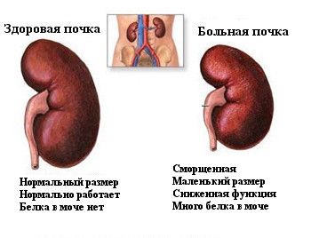 Отличия в здоровой и больной почке