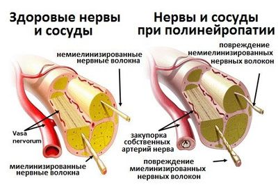 Диагностика и лечение диабетической полинейропатии