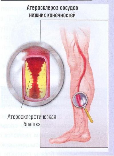 Лечение стеноза сосудов нижних конечностей