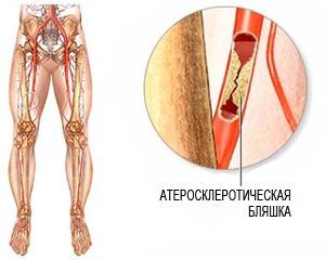 Лечение стеноза сосудов нижних конечностей