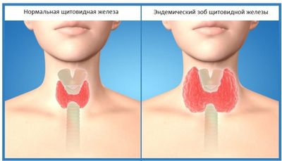 норма и отклонения при зобе