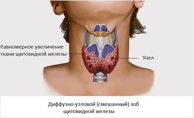 диффузно-узловой зоб