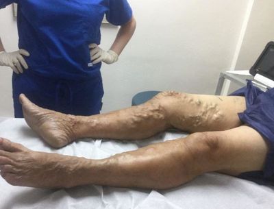 Классификация и лечение флеботромбоза глубоких вен ног