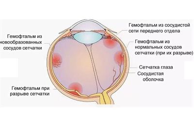 Субтотальный гемофтальм
