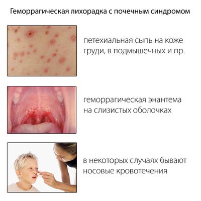 Геморрагическая лихорадка с почечным синдромом