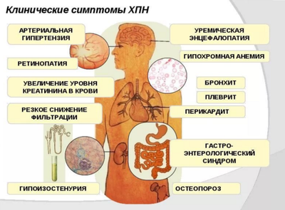 хроническая почечная недостаточность