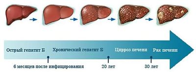 Признаки гепатита B