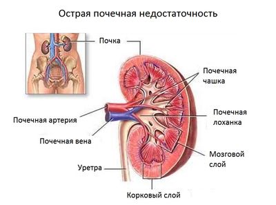 острая почечная недостаточность