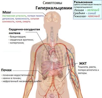симптомы гиперкальциемии