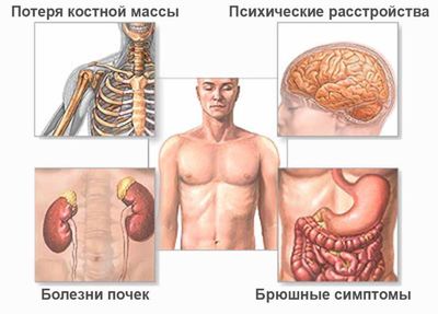гиперпаратиреоз