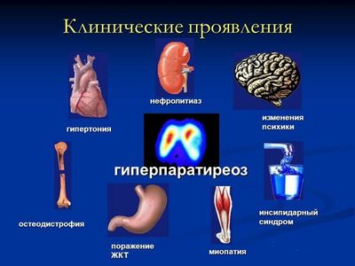 клинические проявления гиперпаратиреоза