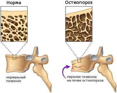 остеопороз