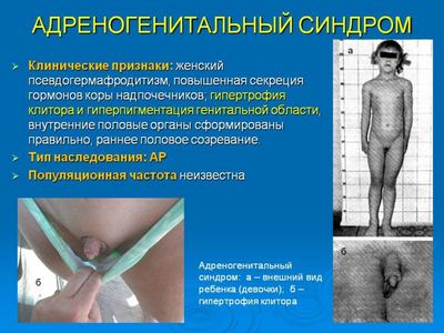 синдром адреногенитальный