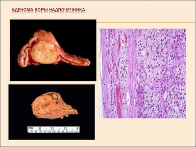 аденома коры надпочечника