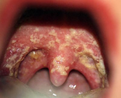 Гонорея горла введение