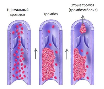 тромбоз