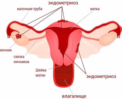 эндометриоз