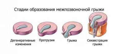 степени грыж