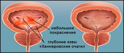 Ханнеровские очаги