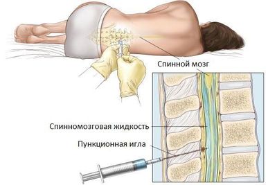 пункция