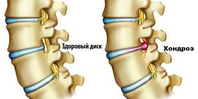 как лечить хондроз