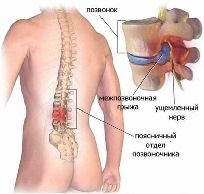 Развитие остеохондроза поясничного отдела
