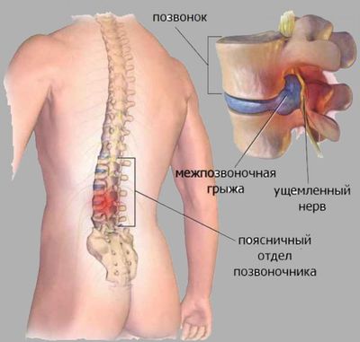 Симптомы и лечение пареза стопы