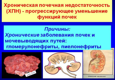 хроническая почечная недостаточность