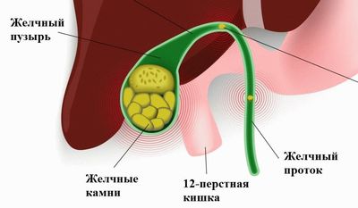 Когда камни в желчном пузыре можно лечить без операции