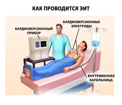 Проведении кардиоверсии