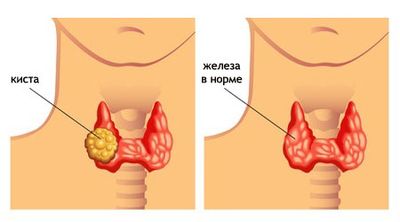 киста щитовидки