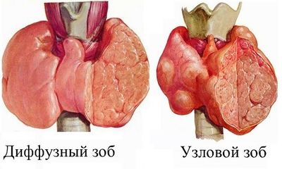 диффузный и узловой зоб