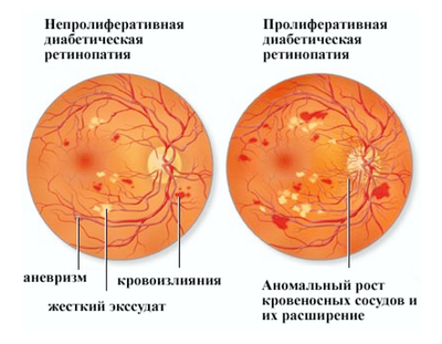 стадии ретинопатии