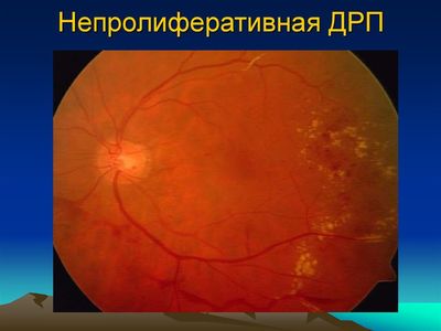 Непролиферативная дрп