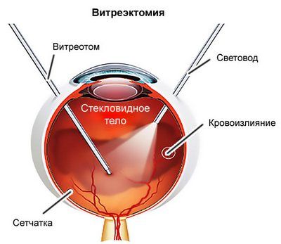 витректомия