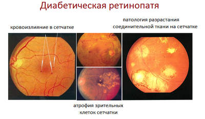 ретинопатия диабетическая