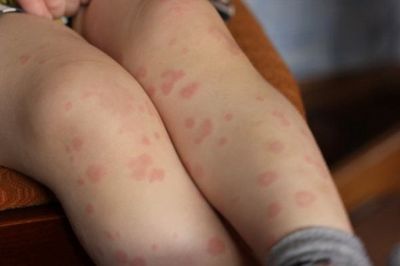 Красные сухие пятна на ногах у ребенка
