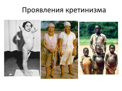 проявление кретинизма