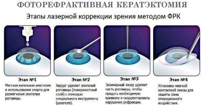 Фоторефракционная кератэктомия