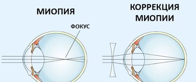 Миопия
