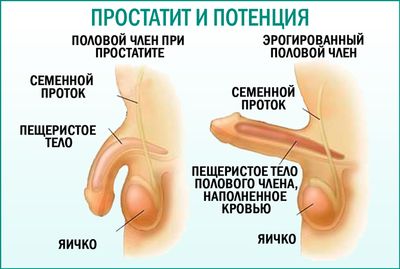 Как простатит влияет на потенцию?