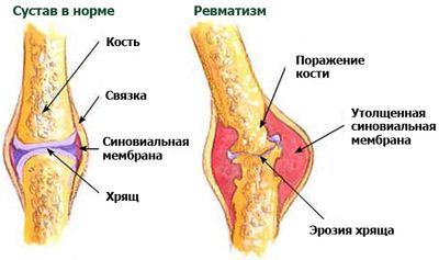 ревматизм