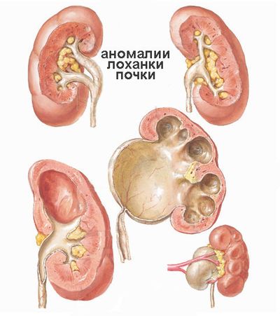 аномалии почечной лоханки