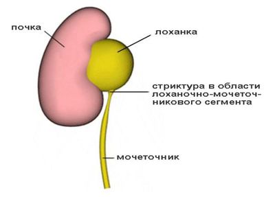 Стриктура