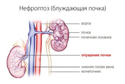 нефроптоз