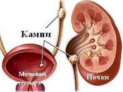 мочекаменная болезнь