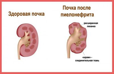 нефрит